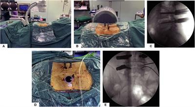 Full Endoscopic Posterolateral Transarticular Lumbar Interbody Fusion Using Transparent Plastic Working Tubes: Technical Note and Preliminary Clinical Results